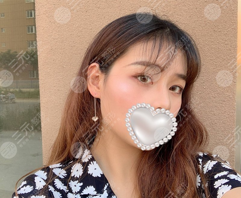 长治市医院整形美容科双眼皮案例