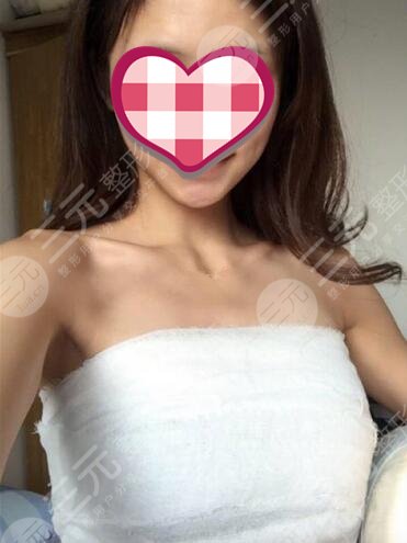 上海九院隆胸过程案例