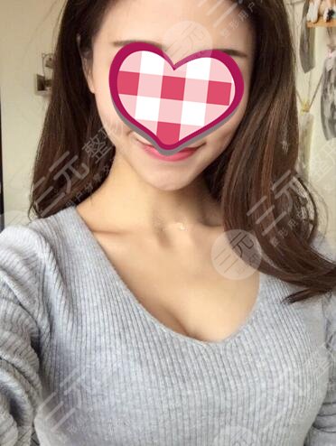 上海九院隆胸过程案例