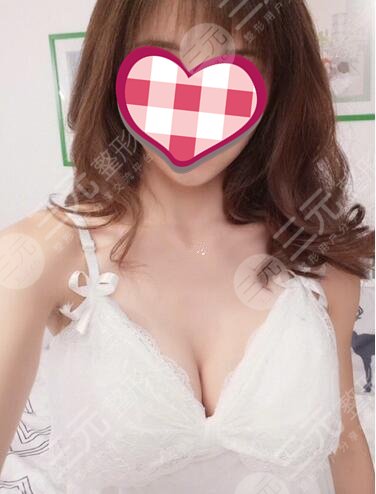 上海九院隆胸过程案例