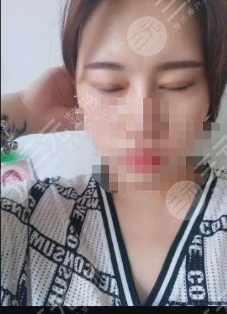 做双眼皮手术之后