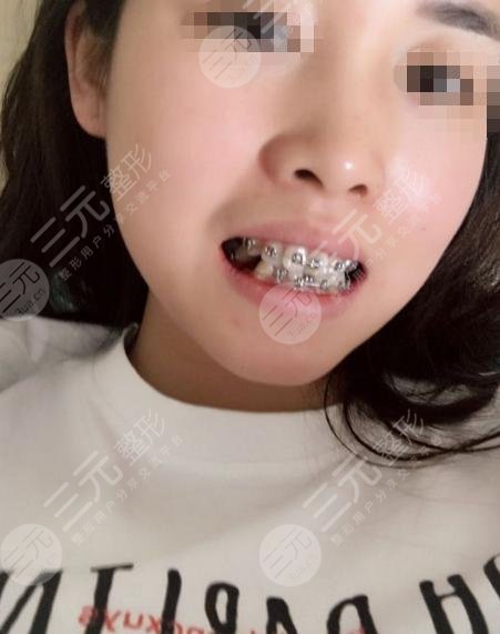 牙齿矫正30天