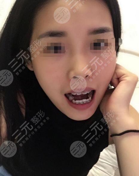 牙齿矫正术后45天
