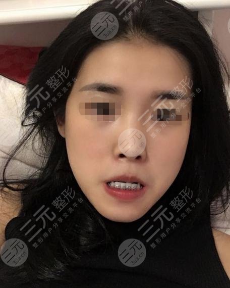 牙齿矫正术后60天