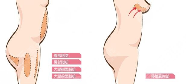 自体脂肪隆胸多少钱呢？