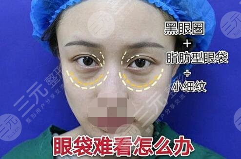 祛眼袋案例前