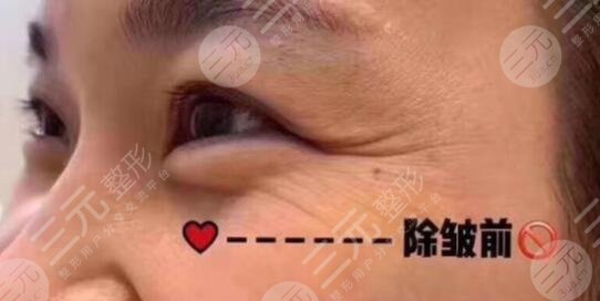 面部年轻化案例前