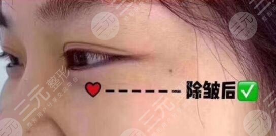 面部年轻化案例后