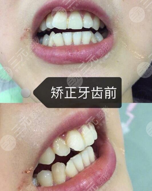 牙齿矫正案例