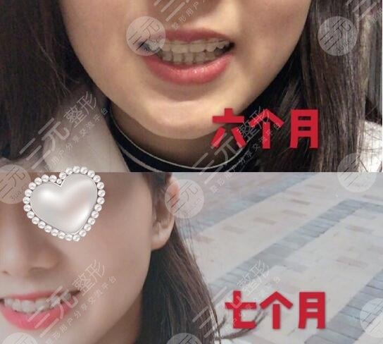 牙齿矫正案例