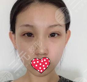 金华市中心医院光子嫩肤案例