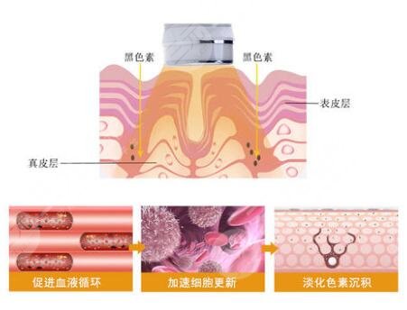 激光嫩肤价格是多少钱