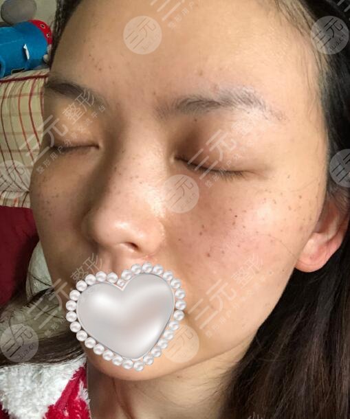 东莞康华医院美容科祛斑案例