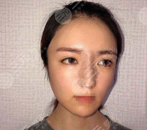 石家庄美联臣隆鼻案例