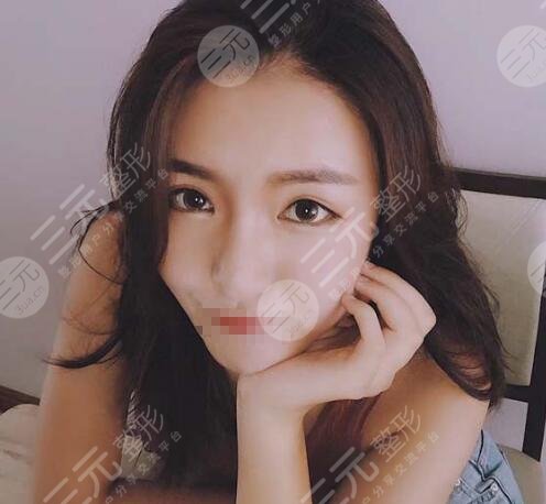 石家庄美联臣隆鼻案例