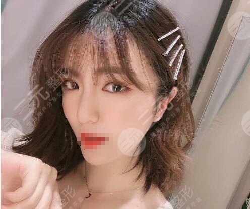 石家庄美联臣隆鼻案例