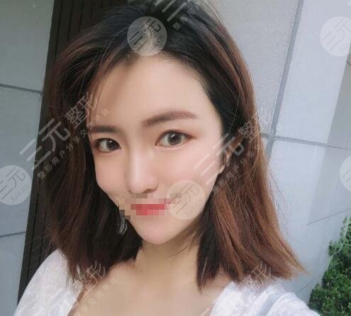 石家庄美联臣隆鼻案例