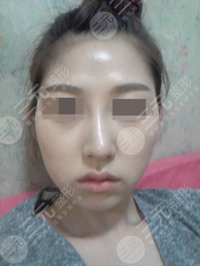 何照华做下颌角怎么样
