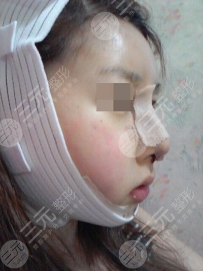 何照华做下颌角怎么样