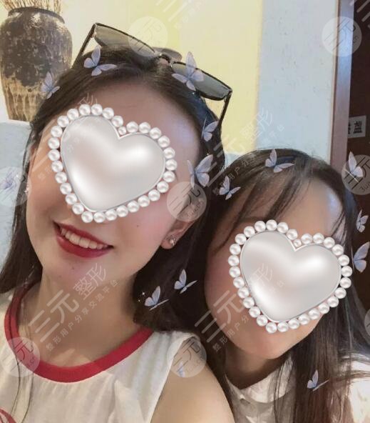 牙套矫正案例