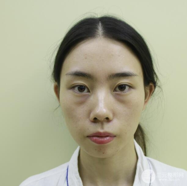 面部除皱案例：
