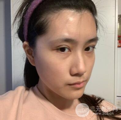 韩式隆鼻案例：