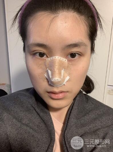 韩式隆鼻案例：