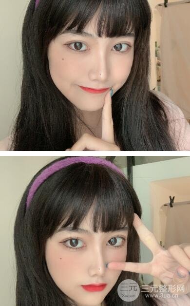 韩式隆鼻案例：