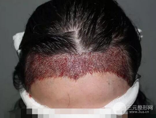 郑大一附院植发案例