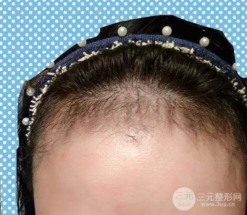 郑大一附院植发案例