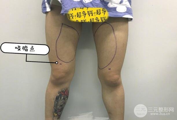 抽脂价格怎么算的?抽脂减肥价格1览表~