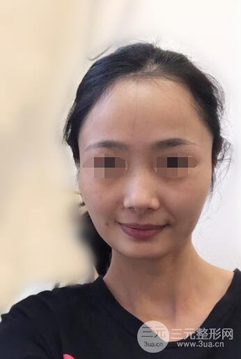 面部吸脂案例