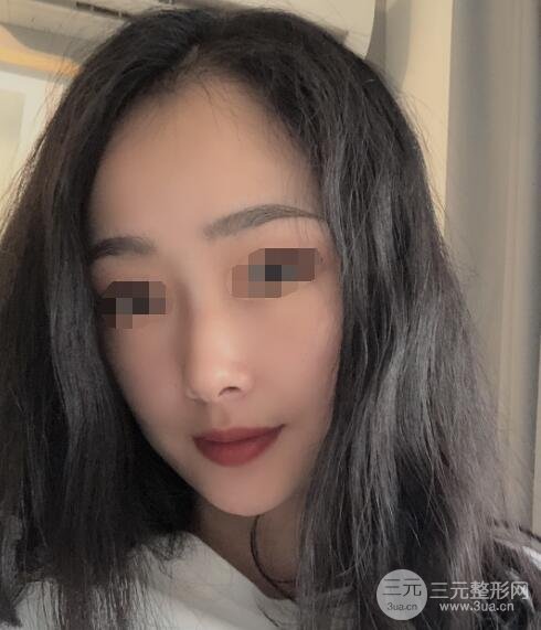 面部吸脂案例