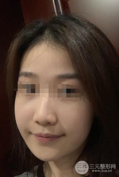 全脸吸脂案例