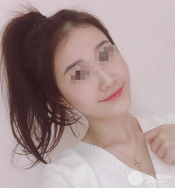 全脸吸脂案例