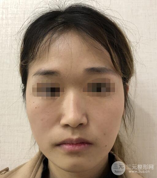 脸颊吸脂案例