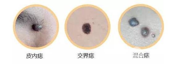 上海九院点痣多少钱一颗?
