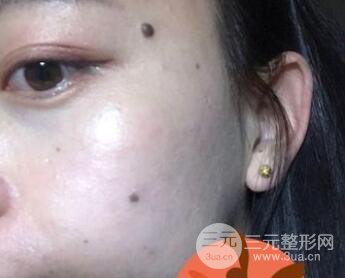 5月7号点痣经历术前