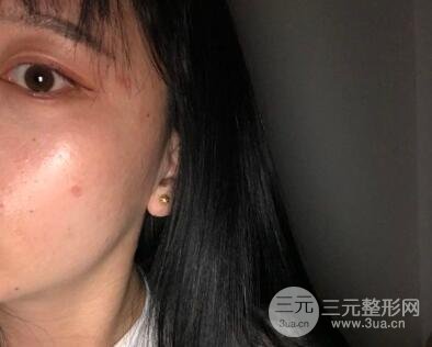 5月7号点痣经历术后一个月