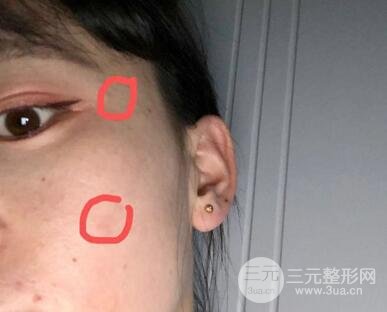 5月7号点痣经历术后3个月