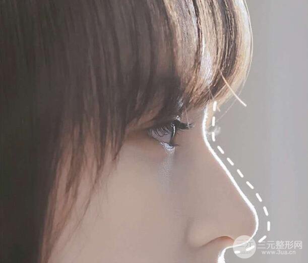 隆鼻整形多少钱一般？恢复过程5个月记录！