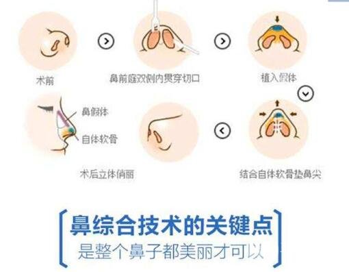 隆鼻整形多少钱一般?