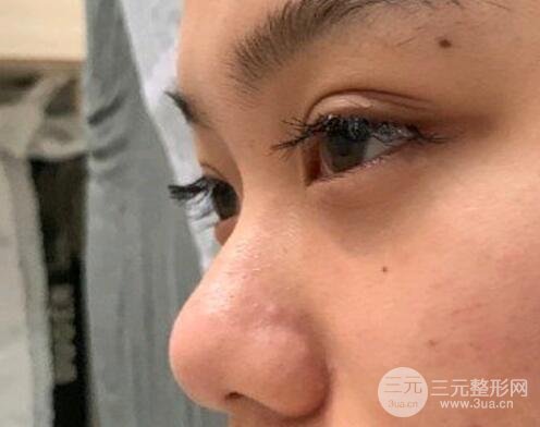 隆鼻整形术前