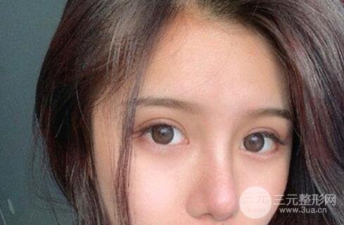 隆鼻整形术后一个月