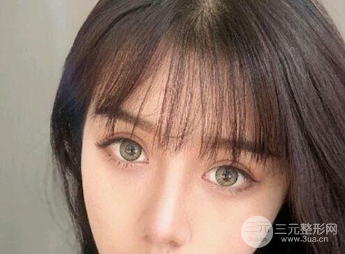 隆鼻整形术后4个月