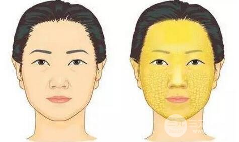 填充面部脂肪术多少钱_面部脂肪填充手术过程_面部脂肪填充术