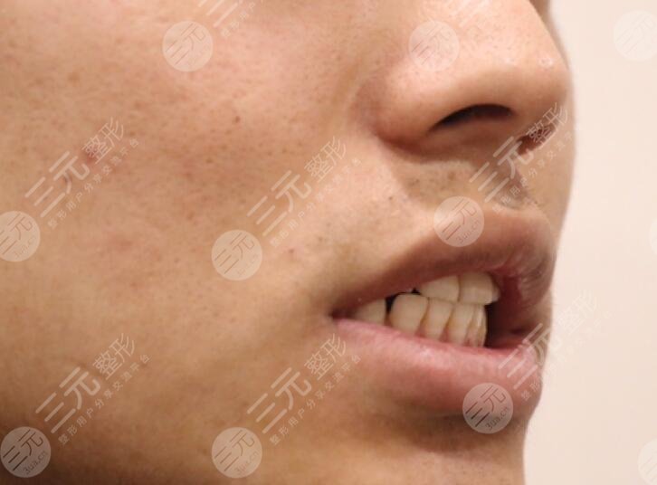 邯郸三医院口腔科牙齿矫正案例前