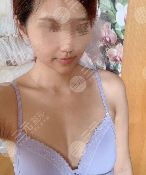 辛敏强吸脂隆胸果