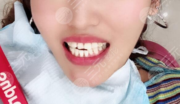 河北医科大学口腔医院牙齿矫正案例前