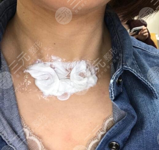 黄晓琴激光祛疤手术中 敷麻药